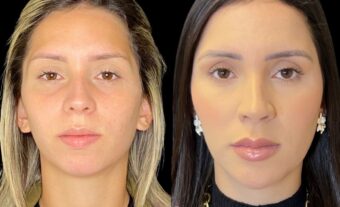 Preenchimento facial ácido hialurônico