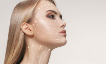 Lifting com fios e bioestimuladores de colágeno